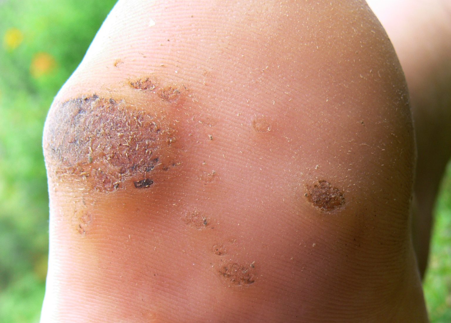 Se débarrasser des verrues plantaires : astuces et traitements verrues plantaires